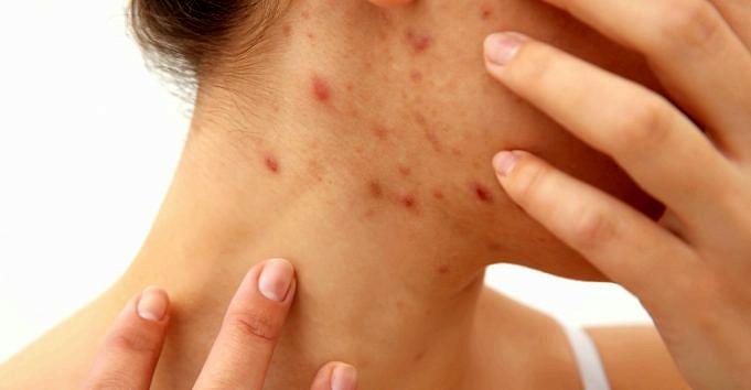 Wie Wählt Man Hautpflegeprodukte Für Fettige, Zu Akne Neigende Haut?